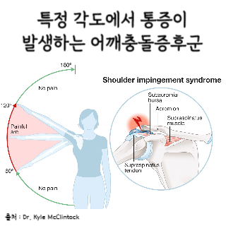 어깨통증원인