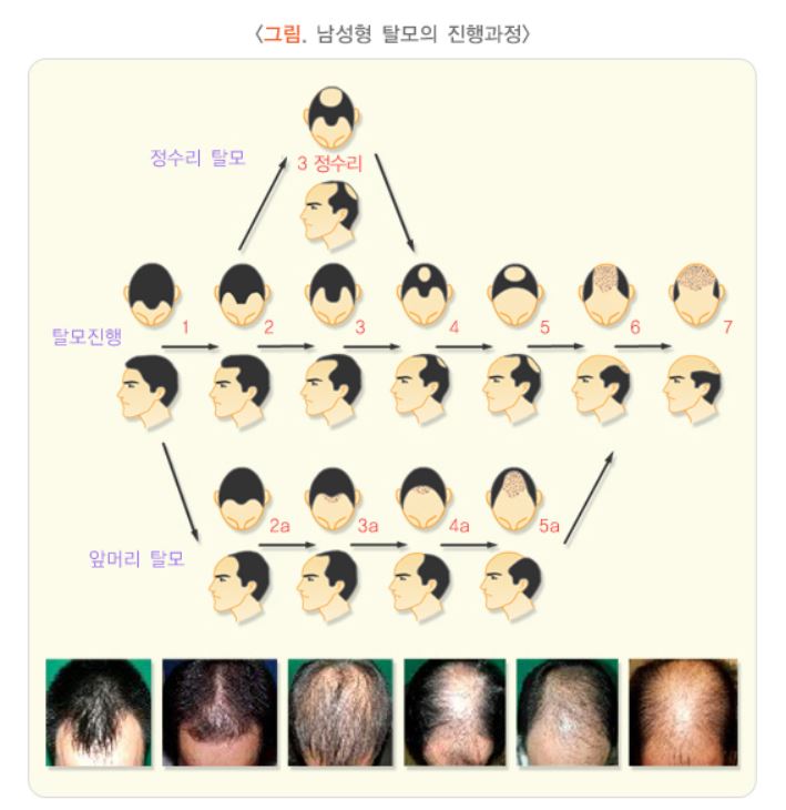 남성형-탈모의-진행과정을-도표로-나타낸-사진
