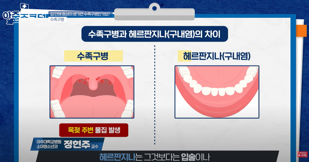 수족구와 구내염의 차이