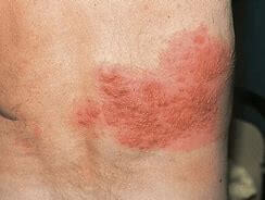 면역력이 떨어졌을 때 아픔을 주는 병. 대상포진 증상, 치료법, 예방법