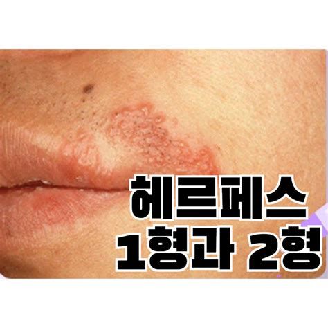 성병증상