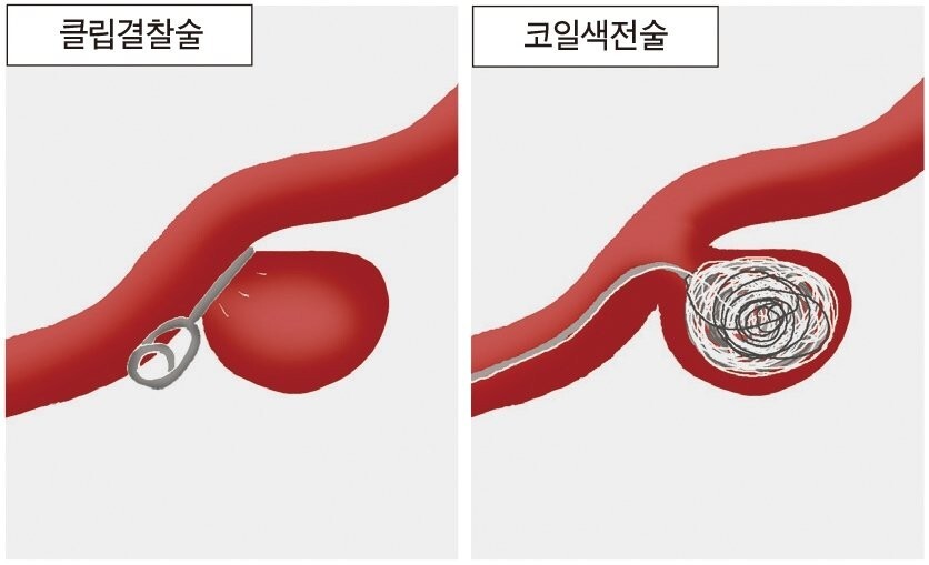 뇌동맥류-치료