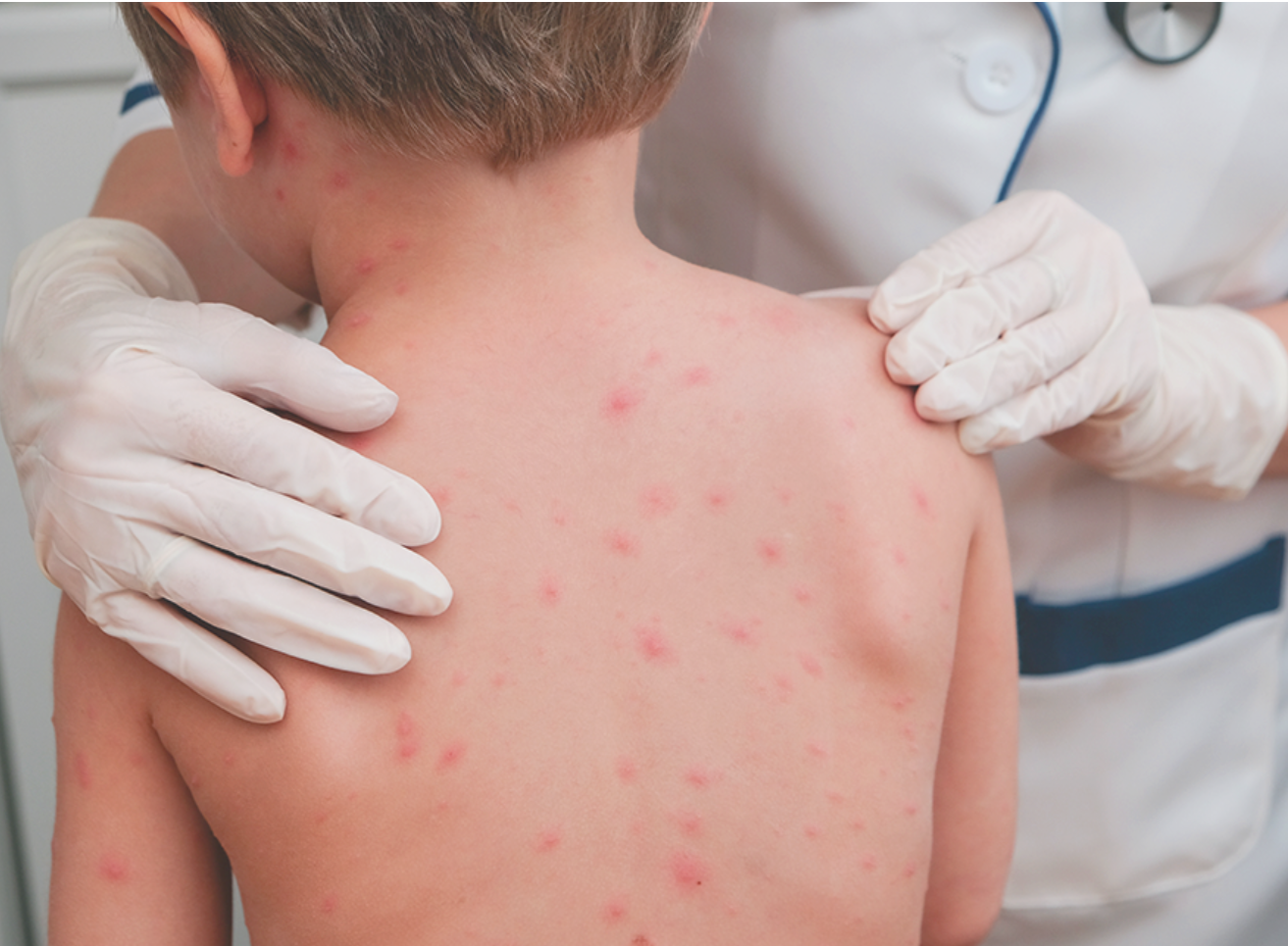 소아-수두-발진