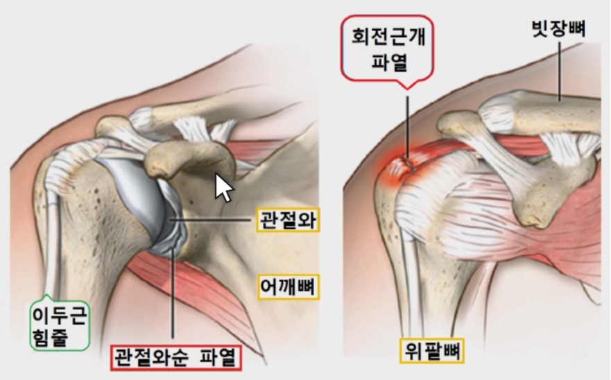 어깨통증 2