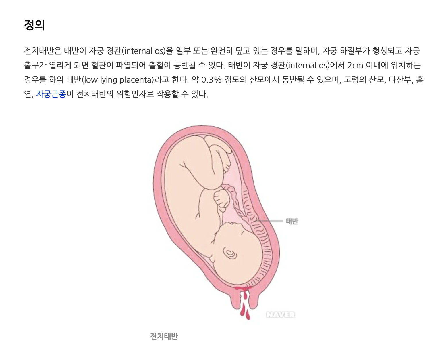 전치태반
