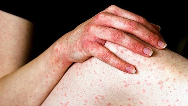 아나필락시스 증상