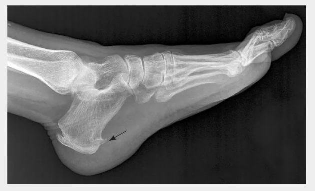 족저-근막염-치료법