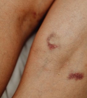 타박상 빨리 낫는 방법