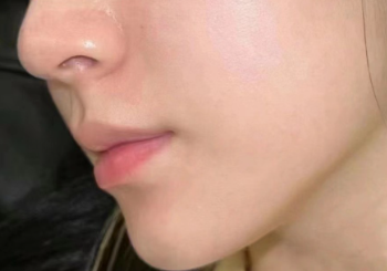 마데카솔겔 수분크림이랑 섞어서 얼굴에 2주 발라봤어요