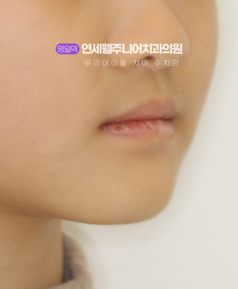 초등학생 주걱턱교정 후 입술과 턱의 균형을 확인하는 정면 모습