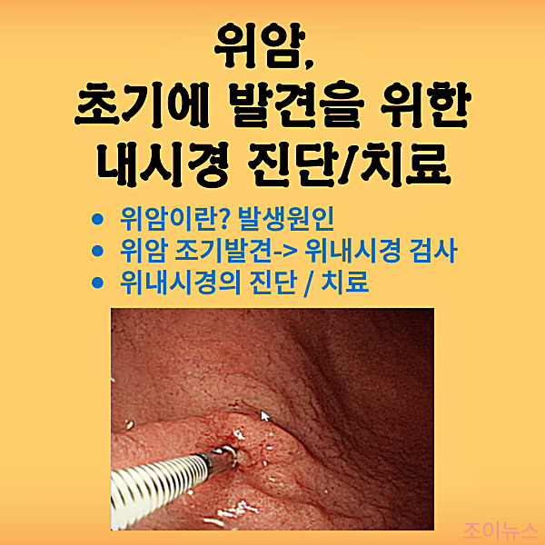 위암 초기 발견을 위한 위내시경 진단과 치료