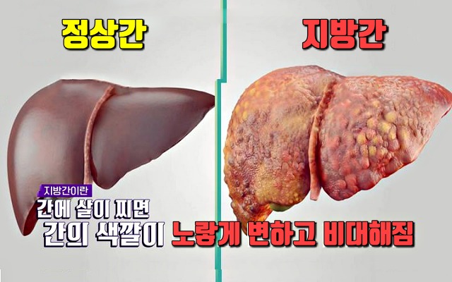 간에 좋은 음식,지방간에 좋은 음식,간암,간경화