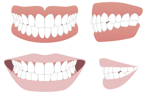이상적인 앞니 맞물림