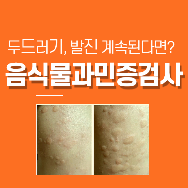 음식물과민증검사