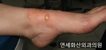 2도 화상 증상 자가치료 회복기간 응급처치법 정리_10