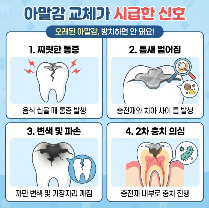 어금니 아말감 수명
