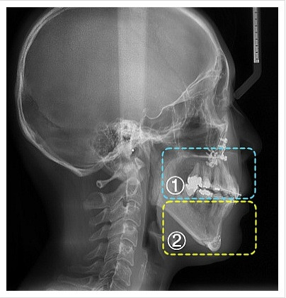 양악수술후(옆면)
