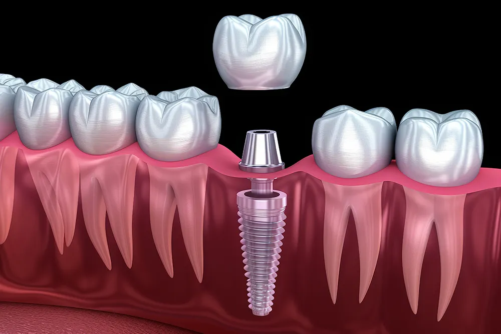 임플란트 1차 수술