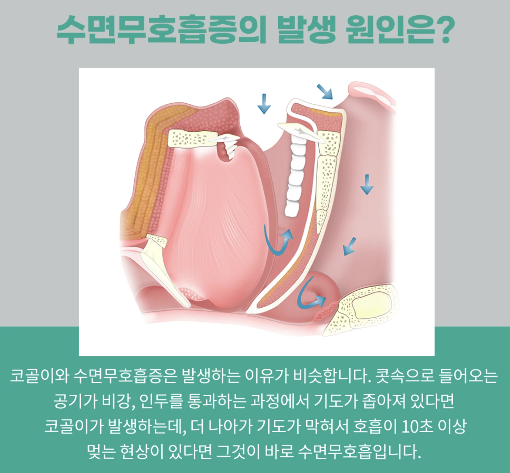 수면 무호흡증