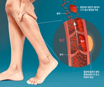 종아리 통증