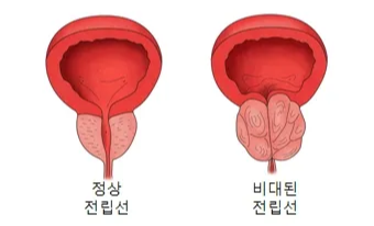 전립선질환