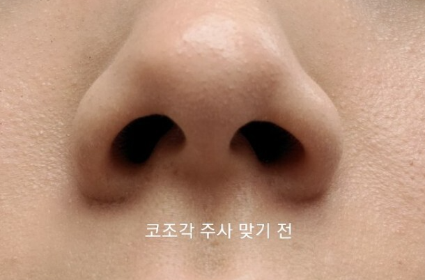 코조각주사 후기