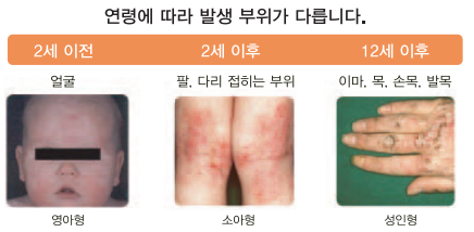 아토피피부염 증상