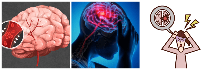 뇌경색 관련 사진 3개