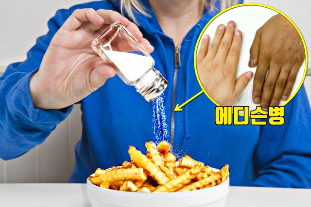 소금 에디슨병 증상 희귀병,이상 식탐 식욕,건강,팁줌 매일꿀정보