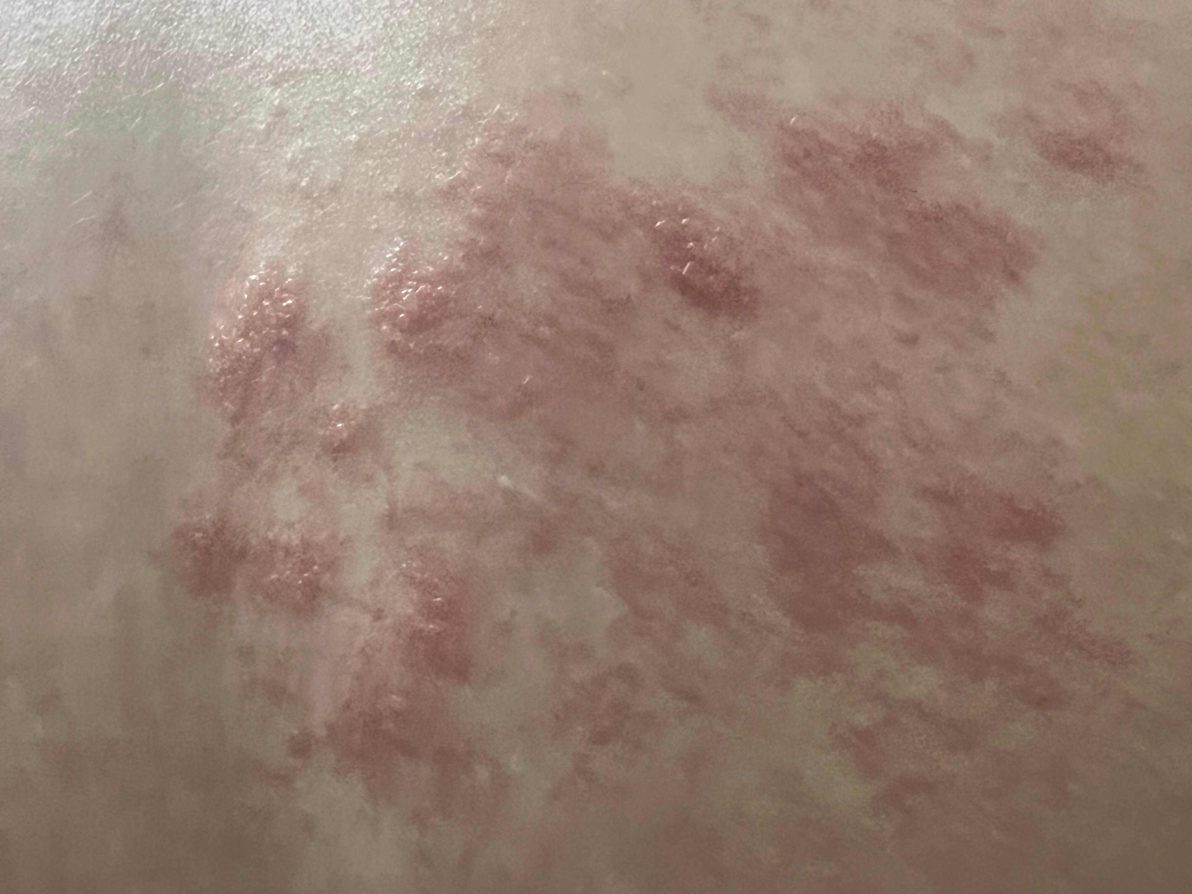 대상포진 수포
