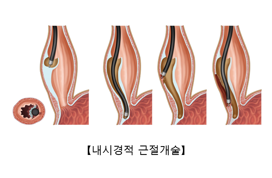 역류성 식도염 목 통증&amp;#44; 삼킬 때 불편한 이유