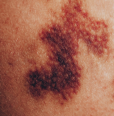 멍이 잘 드는 이유와 오래가는 이유&amp;#44; 병일까? 빨리 빠지는법은?