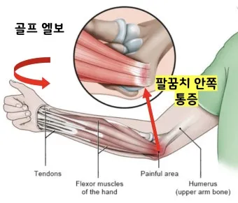 팔꿈치 통증 원인 6가지증상운동법예방법치료법까지_2