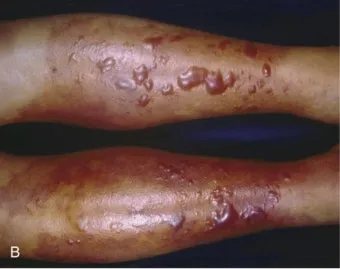 패혈증이란 무엇인지 원인 증상 치료 예방법_18