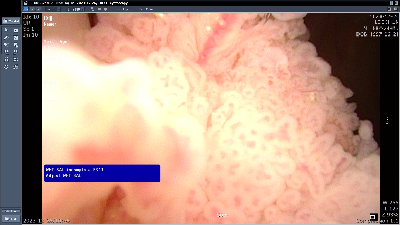 방광암 내시경 조직검사