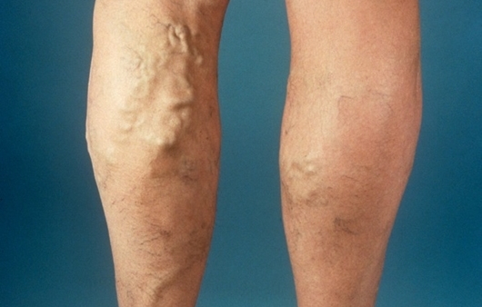 다리-혈관-질환-허리-무릎-통증-관련성-차이점-구별법-진단과