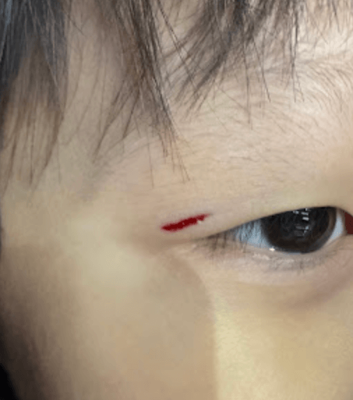 눈옆-상처