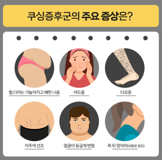 쿠싱증후군증상