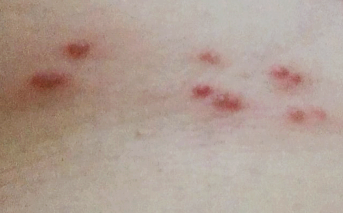 대상포진-신경통