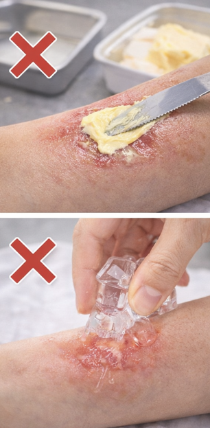 잘못된 화상 대처법과 주의 사항 관련 사진