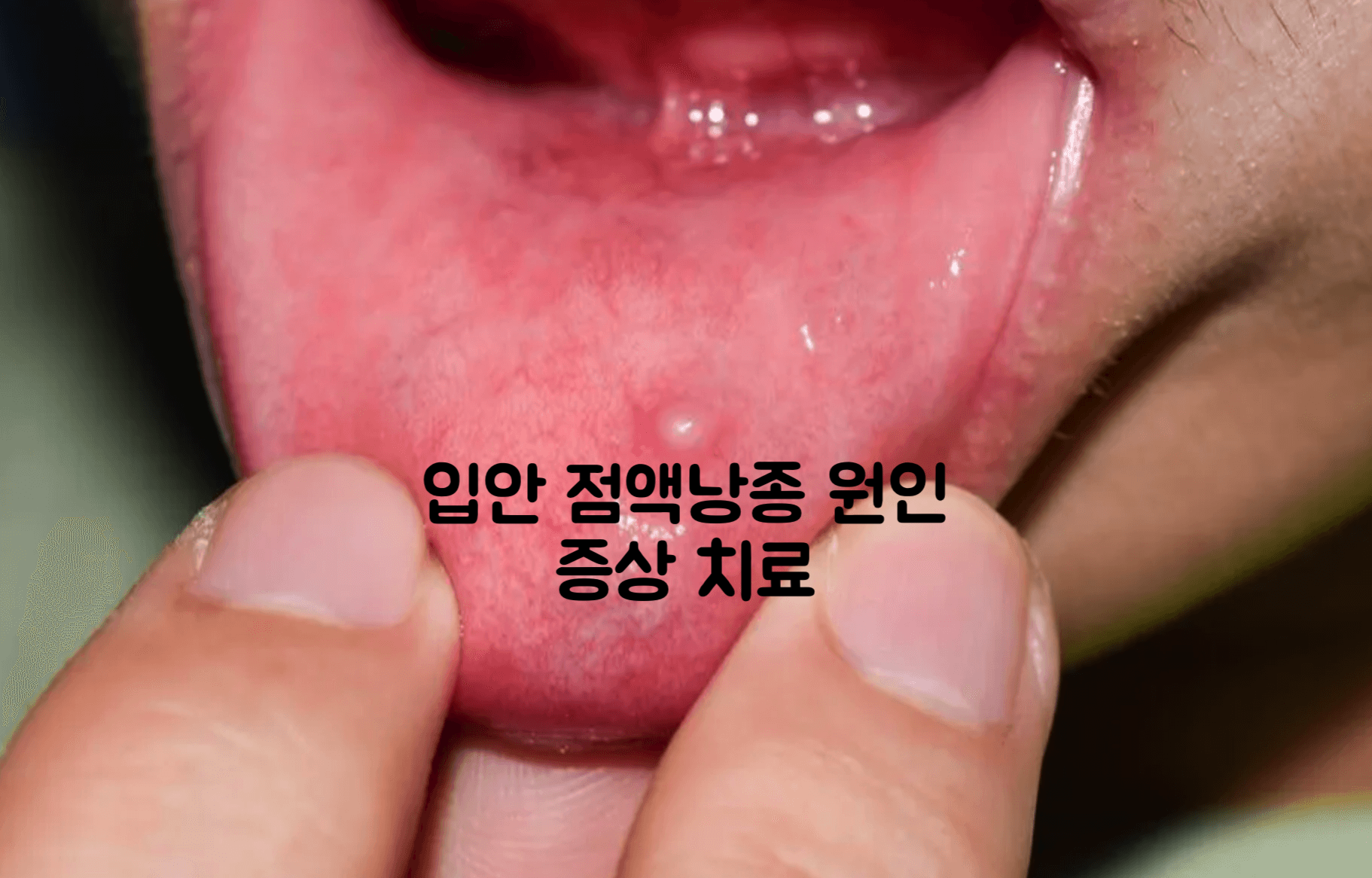 입안 점액낭종