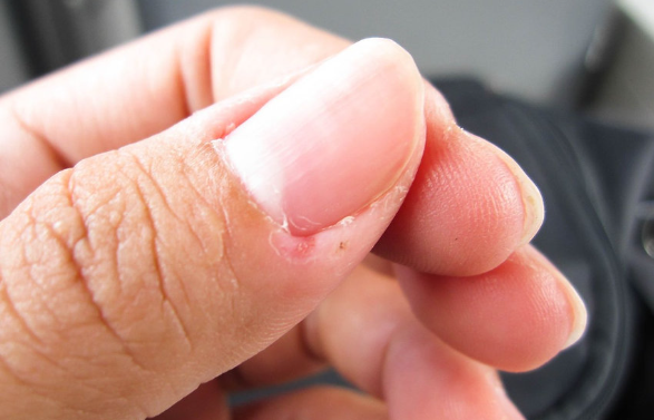 손바닥 껍질이 벗겨지는 이유