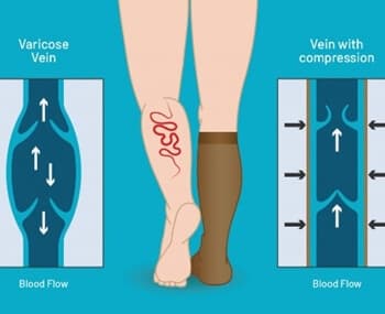 하지정맥류 자가 진단 초기 증상 좋은 운동 예방