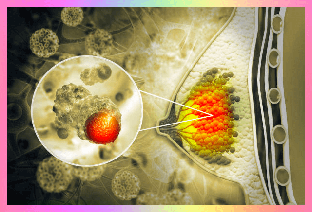 유방암 원인 증상