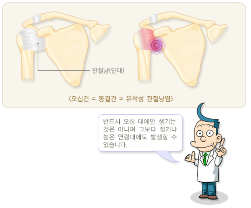 오십견.동결견.유착성 관절낭염