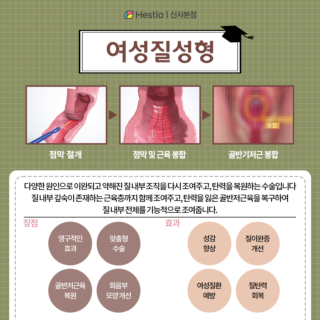 여성질성형 장점과 효과는 무엇인가요?