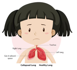 소아 폐렴 초기증상 원인 치료