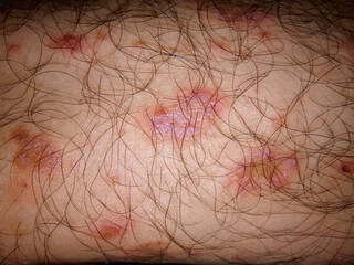 장미색 비강진 원인, 치료, 재발 등에 대해 알아봤습니다. 장미색 비강진은 pityriasis rosea이라고 불리는데요. 어떤 증상과 원인 치료가 있는지 꼼꼼히 읽어보세요!