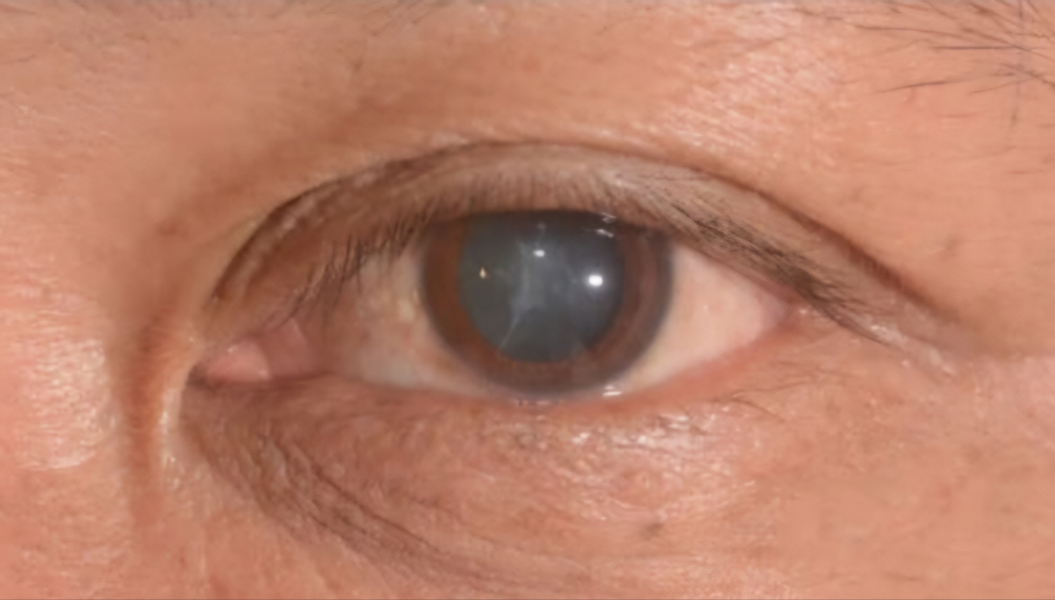 백내장 눈동자 사진