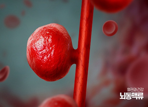 뇌동맥류 증상 체크포인트 (두통, 시야장애, 어지럼증)